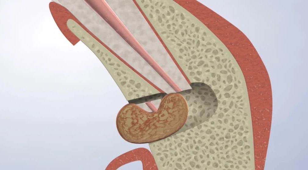 Endodontic Retreatment